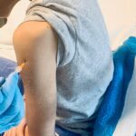 Piemonte: al via le vaccinazioni contro il vaiolo delle scimmie per i soggetti a rischio